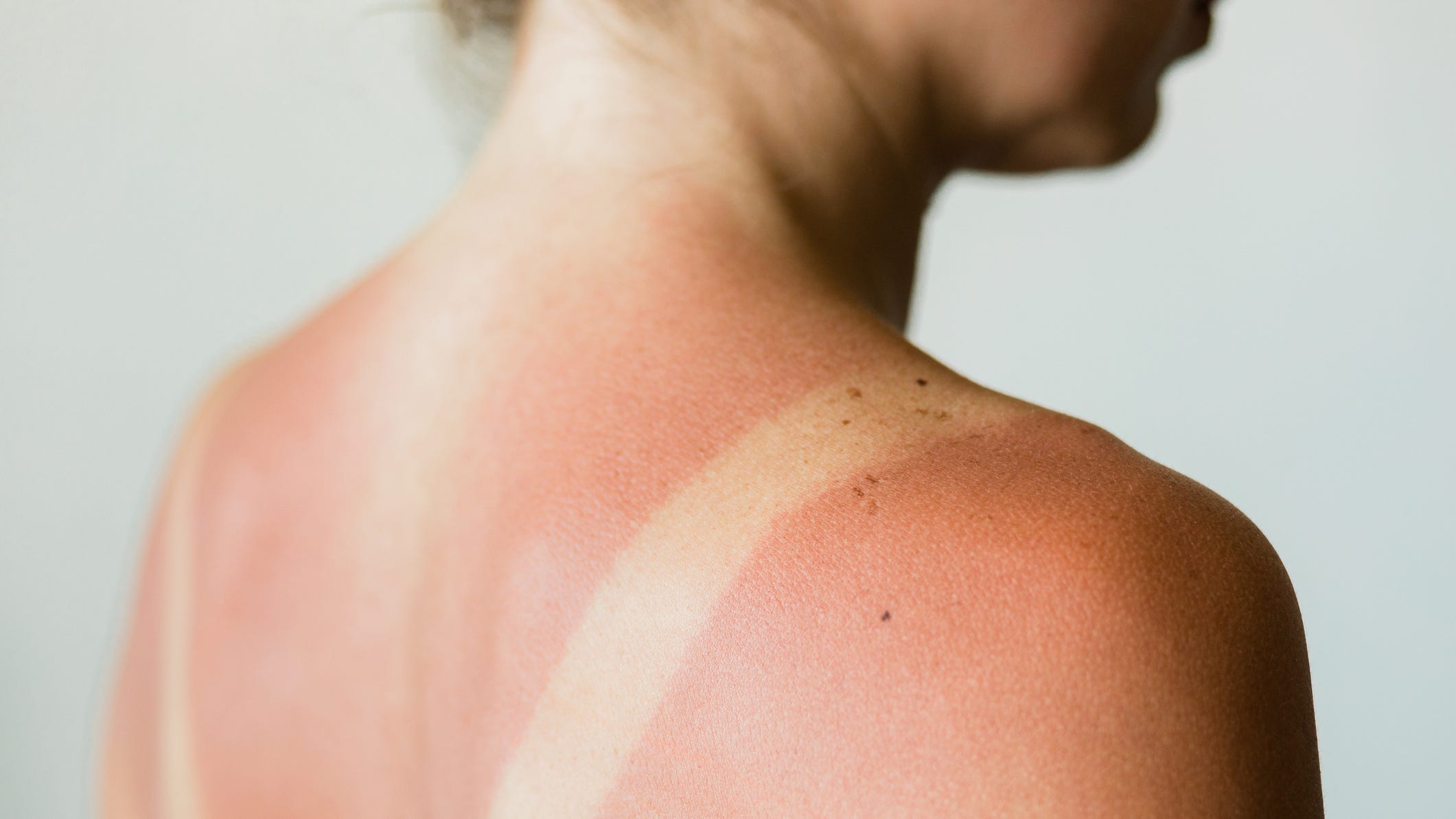 Sunburns And Dermatology: How Dermatologists Can Help